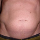Two Months Pre-op. It's a big round muscle that used to be a beer gut!