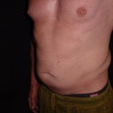Full front pre-op