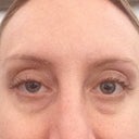 Week 5 droop (42 days after injections; 38 days of droop)