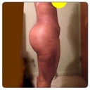 2 weeks post- op- side shot