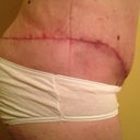 Post Op 34 right side scar