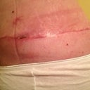 Post Op 34 left side scar