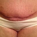Post Op 34 front scar