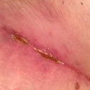 Post Op 35 right groin scar - finally seems to be drying up