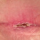 Post Op 35 left hip scar - again, seems to be drying up