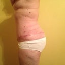Post Op 34 left side view