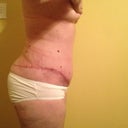 Post Op 34 right side view