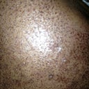 2 days after treatment. These scabs eventually fell off in about 7 days