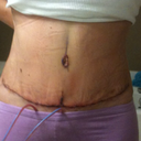 3 day post op