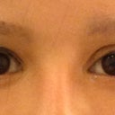 Uneven eyelids