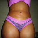 5 months post op.  Scarring from the seroma is not terribly noticeable.