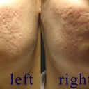 this is before fraxel laser - pic1