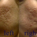 this is before fraxel laser - pic2