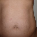 Pre-surgery. 5'4", 125 lbs and fit but just look at that gut!!