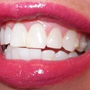 Final picture of teeth after 1-1/2 yrs with Invisalign.  I was not happy with my front upper teeth position, or the outward slant of my bite, or the lower center or right teeth.  I still saw some over-jet.