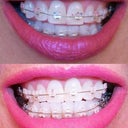 The top photo is day one of the ceramic braces.  The bottom photo is day 15.  So this closes my Invisalign review.  Please read my Ceramic Braces review posted this week:)