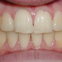 Severe Crowding And Unilateral Crsosbite