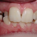 Severe Crowding And Unilateral Crsosbite