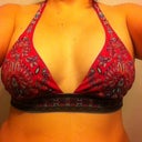 Post op surgery day 397cc sub muscular moderate plus profile