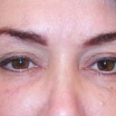 This is immediately after the injection of 1cc syringe of Perlane used on both tear through, and 
cheek.  They are that good at Oasis.