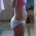Tummy Tuck pre-op