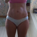 I'm also having lipo of my inner and outer thighs