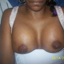 5 days postop. Rt breast doesnt look good to me.