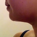 1 day post-op