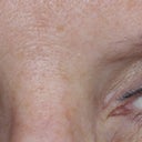 Eyebrow and eyeliner after my procedure.