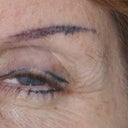 Another closeup of the left eye. Note the gap on the top eyelid where a clump of skin fell off the day after the procedure. Also the liner on the right corner is tilted up.