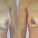 Comparision before and 1 month after explant