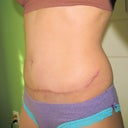4vmonths post op_no big difference from 10 wks