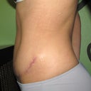 side view. 10 weeks post op
