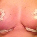 2 weeks after surgery bottoming out already on right side