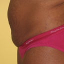 Pre-op side profile