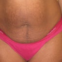 Pre-op pics