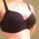 After-6 weeks post op in bra