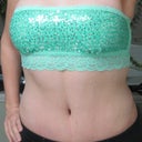 5 months post op