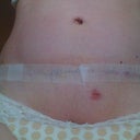 Post-op day 8, TUBE OUT (woo hoo) and scar healing/fading nicely