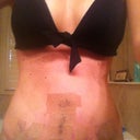 This is me 1 week post-op. So very nice to finally take a shower! I think I will get all the tape off at 2 week mark.  I'm a little scared to actually see the incision. It is very low. I actually brought in this bathing suit bottom on surgery day to make sure it wouldn't go above.
