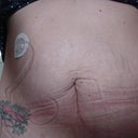 Before- Type 1 Diabetic