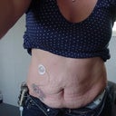 Before- Type 1 Diabetic