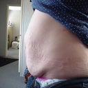 Before- Type 1 Diabetic