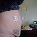Before- Type 1 Diabetic