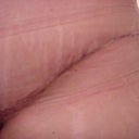 24 days after - Type 1 Diabetic