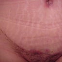 24 days after - Type 1 Diabetic
