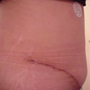 24 days after - Type 1 Diabetic