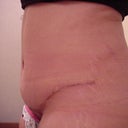 24 days after - Type 1 Diabetic