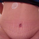 24 days after - Type 1 Diabetic