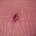 24 days after - Type 1 Diabetic